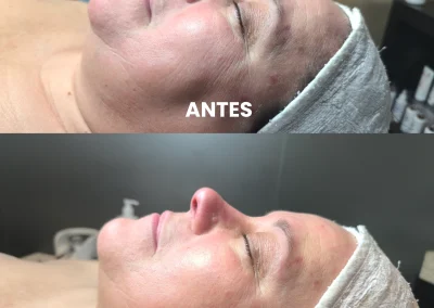 Tratamiento de pieles sensibles